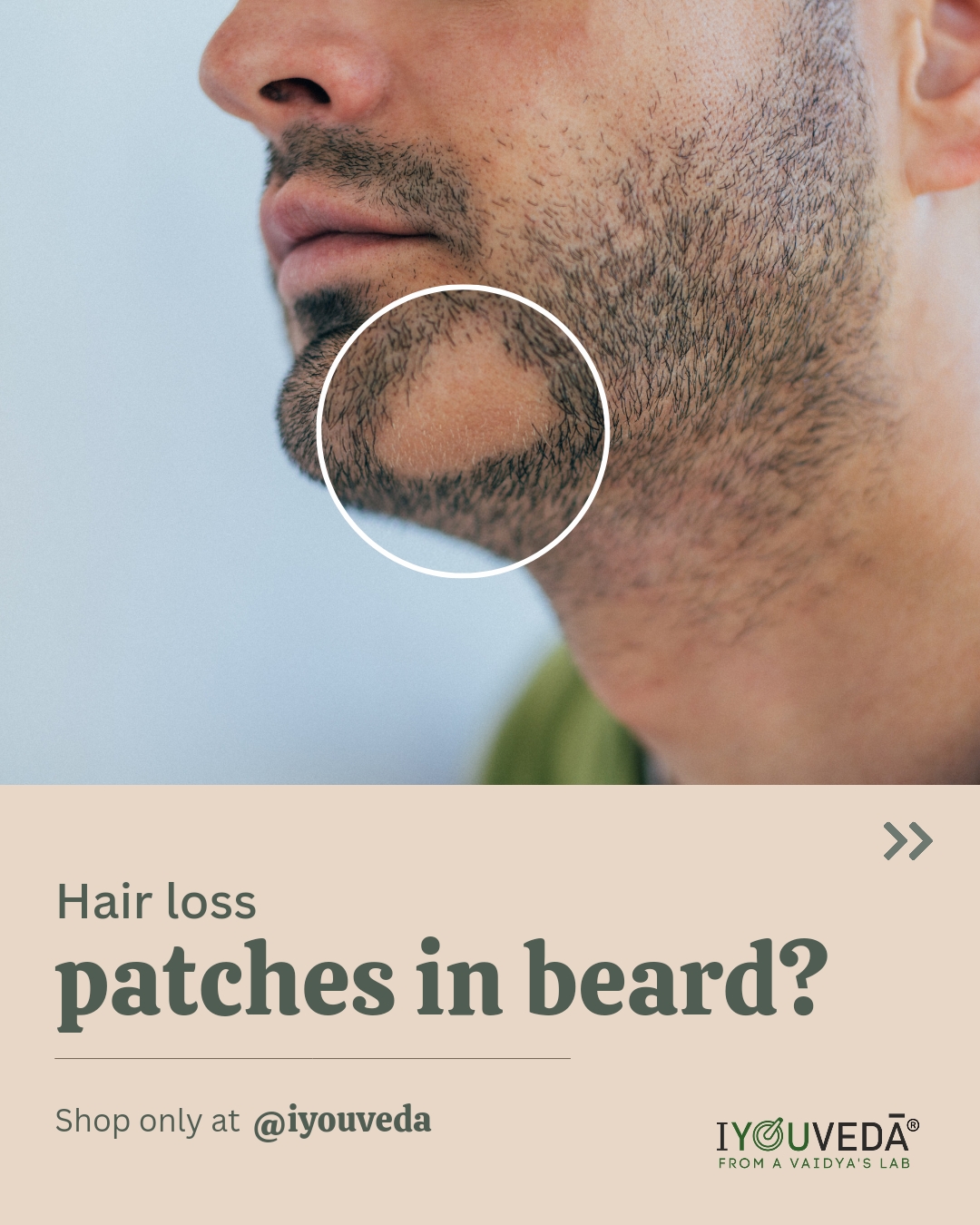 1 Month Aakesha Hair Regrowth Serum pack - Image 6